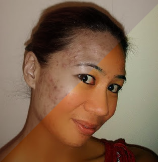 Remove pimples and make smooth skin using Photoshop